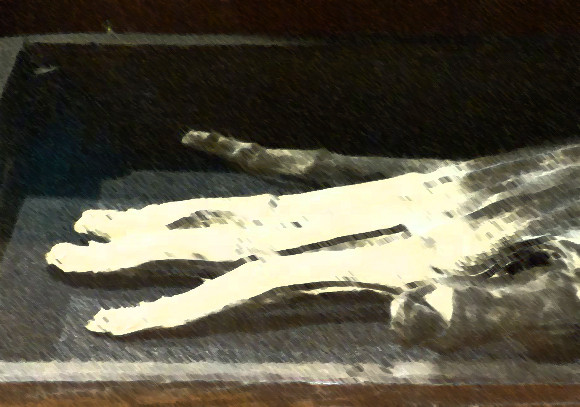 処刑された罪人の右手で作られた魔導具「栄光の手」は実在する。唯一残された標本（イギリス）※閲覧注意