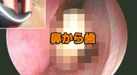 仰天！鼻血が止まらないので病院に行ったら鼻の中に歯が生えていた（閲覧注意）