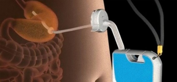 これぞ究極のダイエット？胃に直接管を差してポンプで吸い出す、「アスパイア・アシスト」
