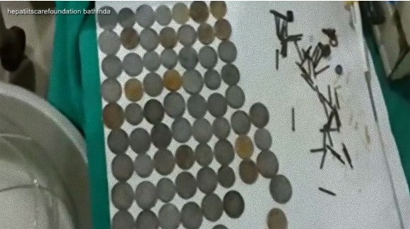 うつ病が引き金になり異食症になった男性、体内から数百のコインや釘が摘出される（インド）