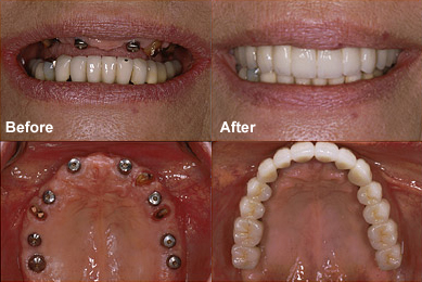 dentalimplants