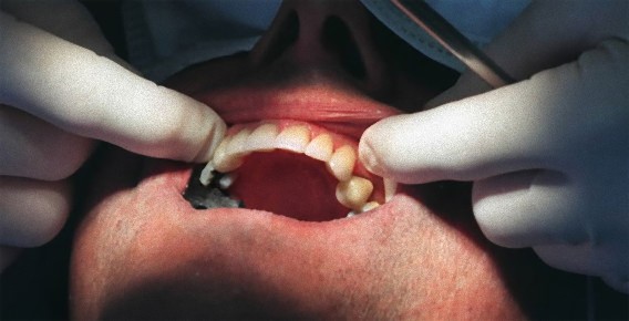 尿から分離したiPS細胞で歯を再生させることに成功（中国研究）