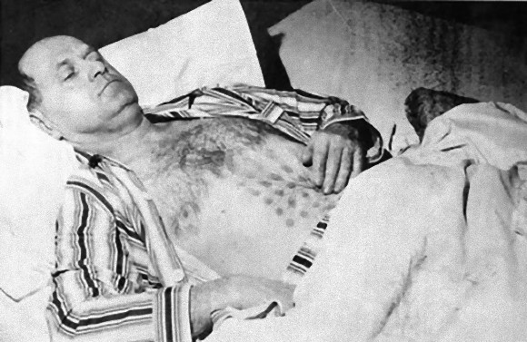この男の身にいったい何が？UFOと遭遇したとされるカナダ人男性の腹部に格子状の火傷