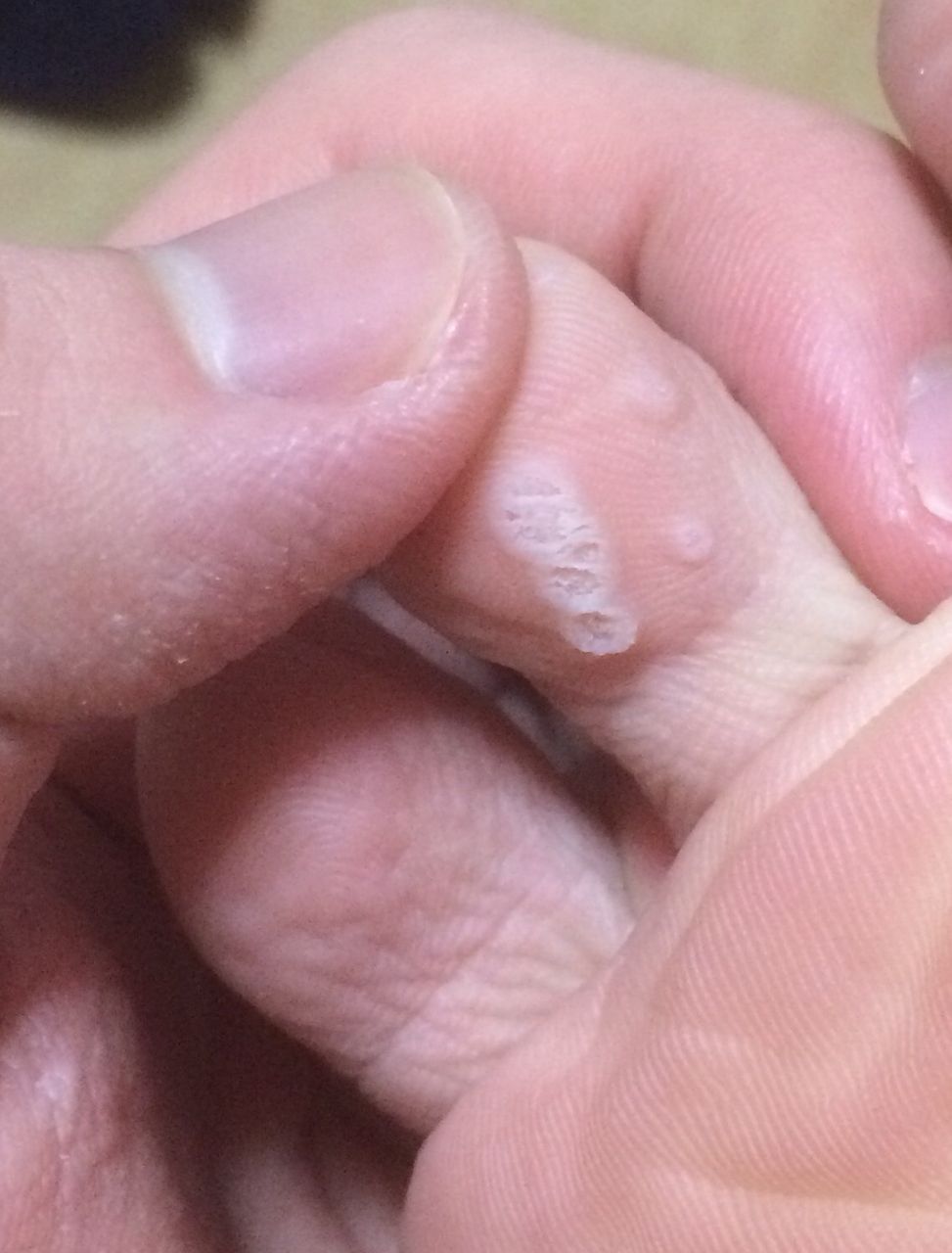 水虫ではない 足に穴開いてるんだが 健康まとめ