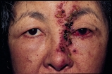 眼瞼腫瘍