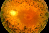 Retinitis-Pigmentosa