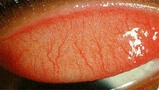 allerg