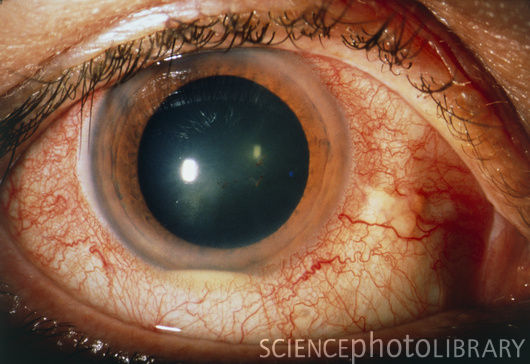 puss in s eye 清澤眼科医院 2411 眼疾患としてのベーチェット病の診断と治療 puss in s eye 清澤眼科医院 2411 眼疾患としてのベーチェット病の診断と治療