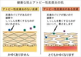 アトピー性皮膚炎