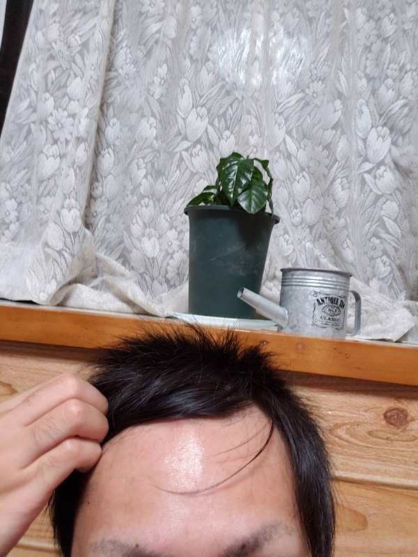俺ってハゲなんか?