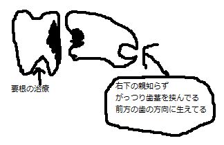 【2ch】コピペ情報局 : <b>虫歯</b>の恐怖