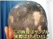 薄毛-脱毛症-違い-a