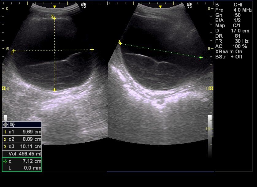 膀胱炎症 膀胱炎有什么症状 妇女膀胱炎有什么症状 男性膀胱炎的症状