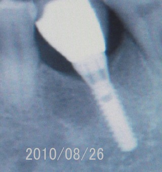 after3years implant