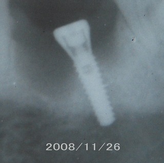implant