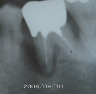 before implant