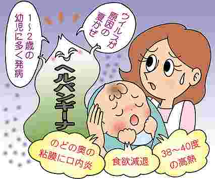 ヘルパンギーナ