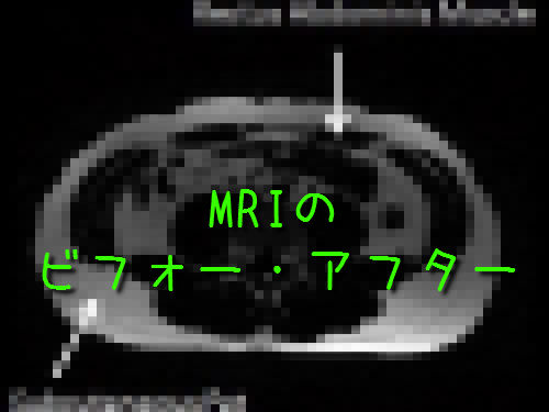 MRIのビフォー・アフター00