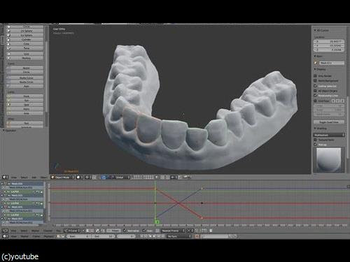 3Dプリンターを使って自分の歯を矯正00