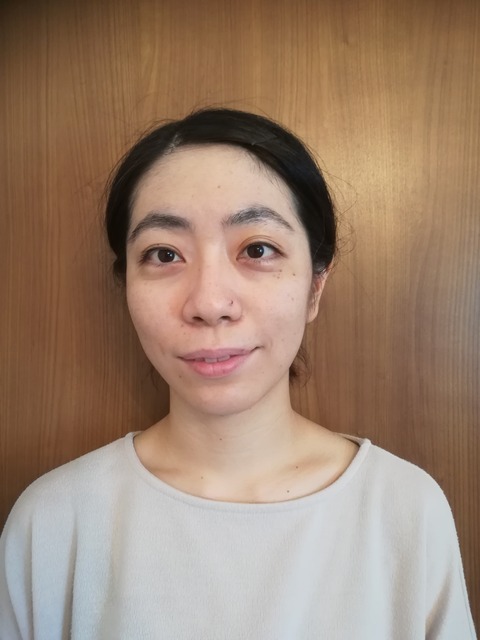 上田式美容鍼®体験記2回目 後jpg
