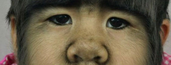 狼症候群という奇病