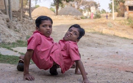 インドの結合双生児は4本の腕と2本の足でたくましく生きている3