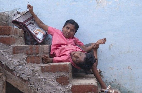 インドの結合双生児は4本の腕と2本の足でたくましく生きている2