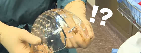3Dプリンターで作製した人工の頭蓋骨の移植に成功!