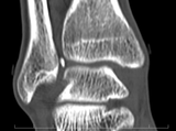 ct2