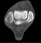 ct1