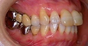 whitening10