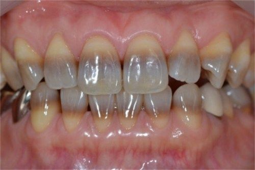 Tetracycline_stains