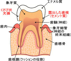 知覚過敏mig