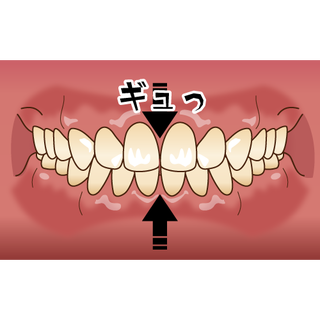 bruxism003