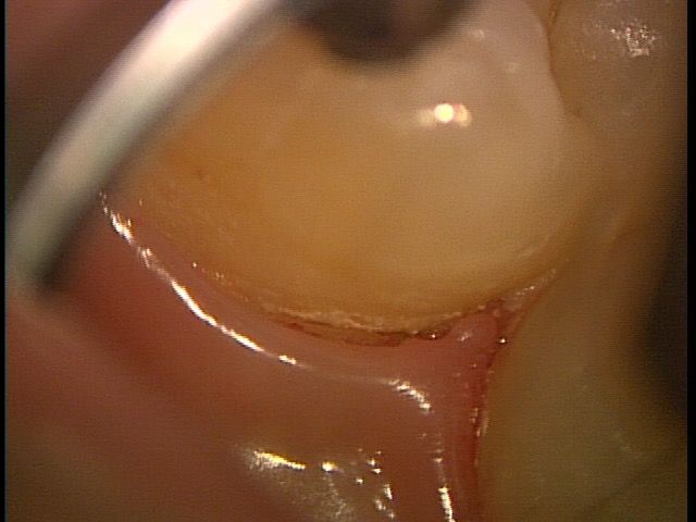 subvgingival2