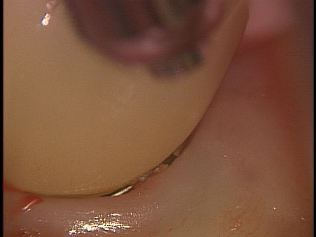 implant1