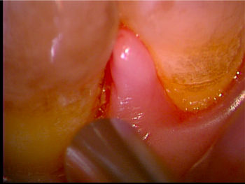 gingivitis3