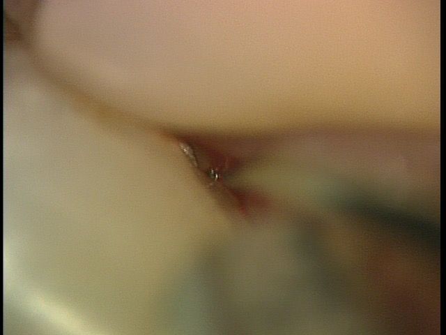 SRP3