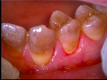 gingivitis1