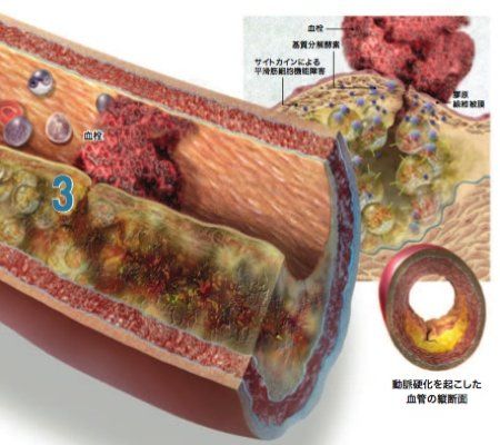 periodontal disease1