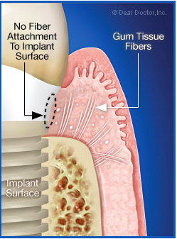 implant