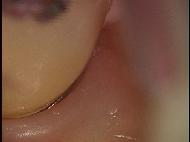 implant3