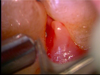 gingivitis4