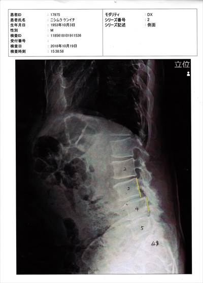 腰椎の変形１０１９_NEW_R