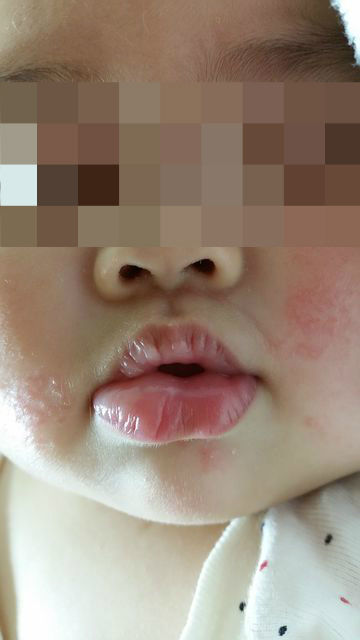 アレルギー 娘の唇が腫れた サーモンが原因 Bmi32 40歳 初出産しました 妊活 出産 育児奮闘中