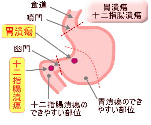 十二指腸潰瘍