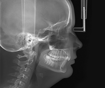 OP-3D_X-ray_LAT-PED-head1_1000px
