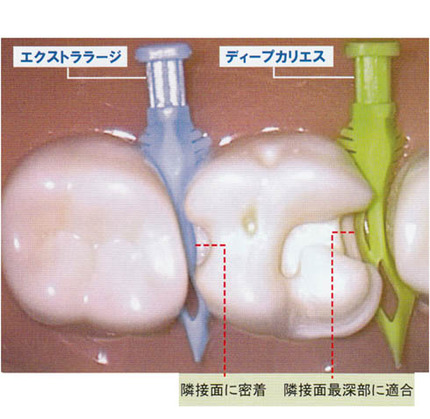 ダイヤモンドウェッジ