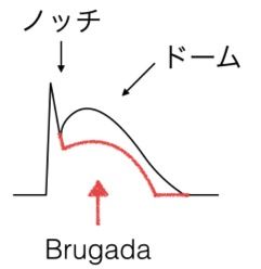 brugada3