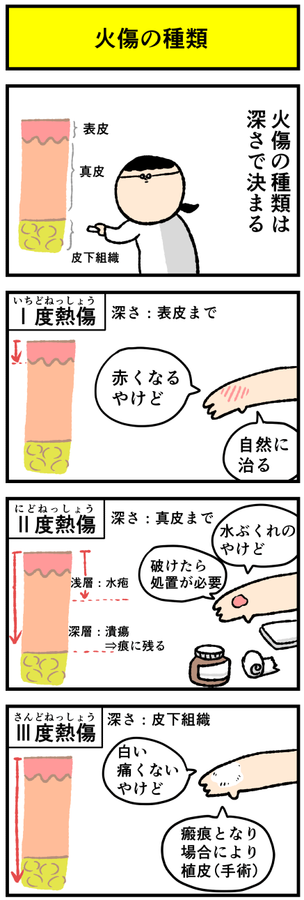 水ぶくれ たら やけど に なっ 火傷（やけど）の水ぶくれの正しい処置は？